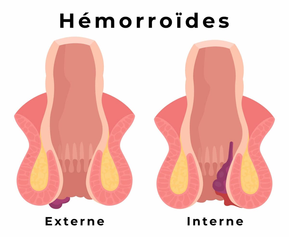 Hemorroide externe : ce que vous devez savoir ! 